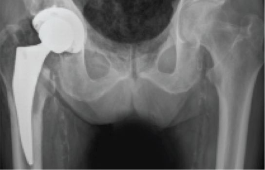 Mako Total Hip Replacement